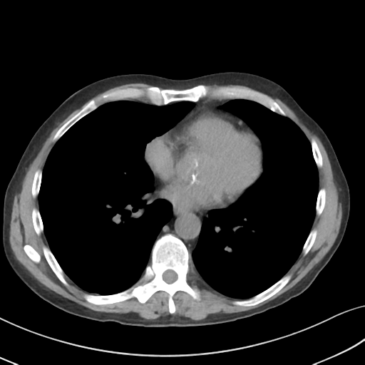 Apical pulmonary metastasis (Radiopaedia 46338-50754 B 40).png