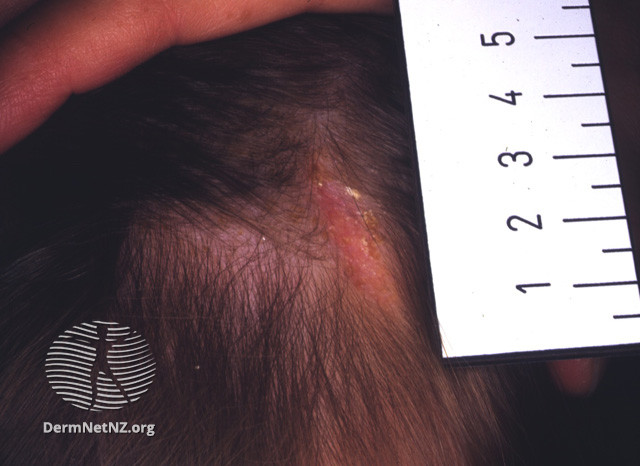File:Aplasia cutis (DermNet NZ lesions-aplasia-cutis).jpg
