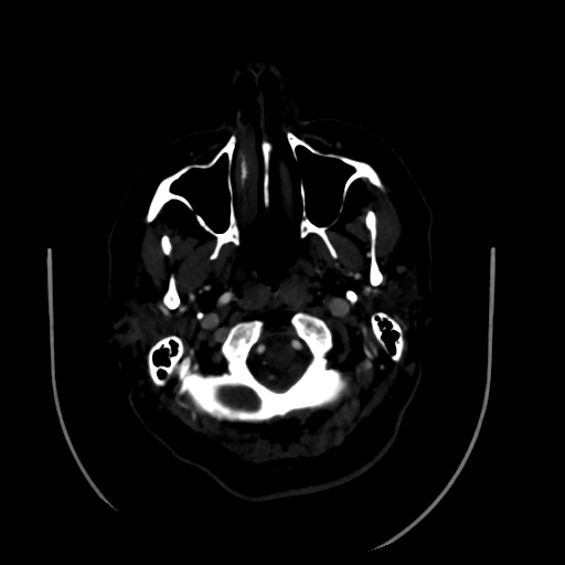 Aplasia of the internal carotid artery (Radiopaedia 61082-68960 A 7).jpg