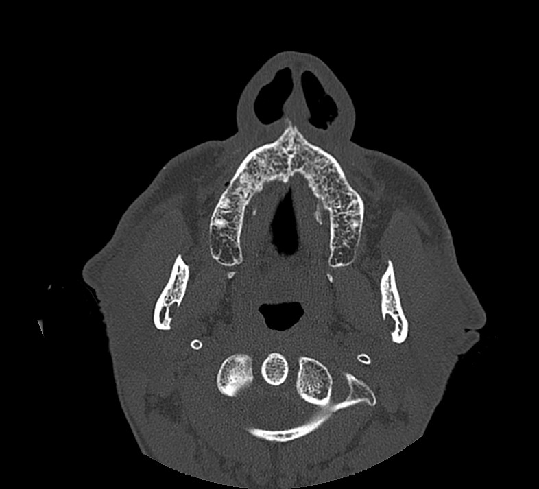 Aplastic maxillary sinuses (Radiopaedia 60030-67561 Axial non-contrast 8).jpg