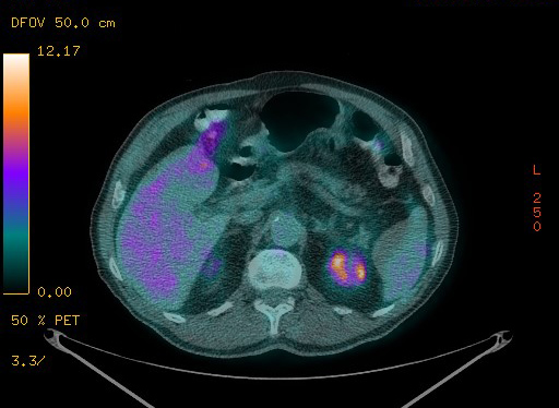 Appendiceal adenocarcinoma complicated by retroperitoneal abscess (Radiopaedia 58007-65041 Axial PET-CT 110).jpg