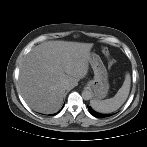 File:Appendicitis and giant appendicolith (Radiopaedia 80251-93588 Axial non-contrast 4).jpg