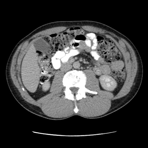 File:Appendicitis complicated by post-operative collection (Radiopaedia 35595-37113 A 33).jpg
