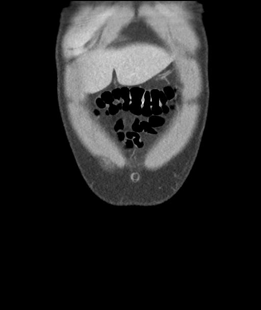 Appendicitis with cecal bar sign (Radiopaedia 31878-32830 A 10).jpg