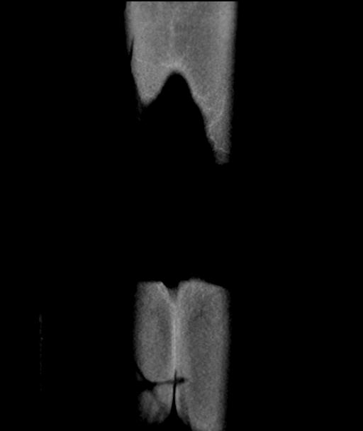 Appendicitis with cecal bar sign (Radiopaedia 31878-32830 A 60).jpg