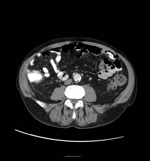 Appendicitis with localized perforation and abscess formation (Radiopaedia 49035-54130 A 53).jpg