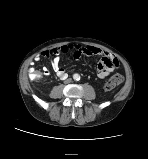 Appendicitis with localized perforation and abscess formation (Radiopaedia 49035-54130 A 54).jpg