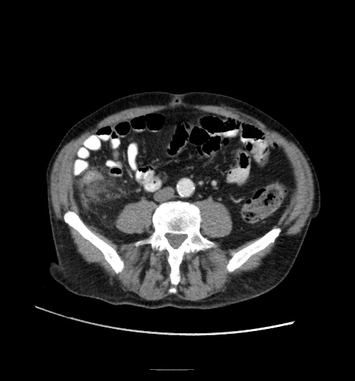 File:Appendicitis with localized perforation and abscess formation (Radiopaedia 49035-54130 A 56).jpg