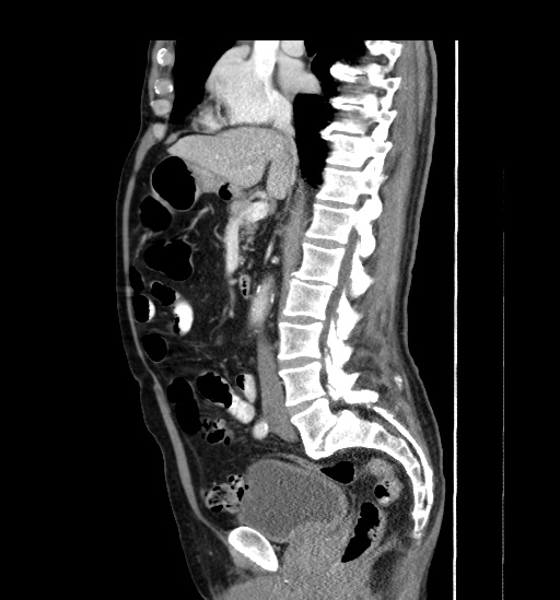 Appendicitis with localized perforation and abscess formation (Radiopaedia 49035-54130 C 30).jpg