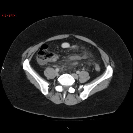 Appendicitis with microperforation- promontoric type (Radiopaedia 27268-27442 C 52).jpg