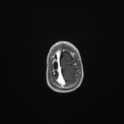Aqueductal stenosis (Radiopaedia 73974-84802 Axial T1 C+ 136).jpg
