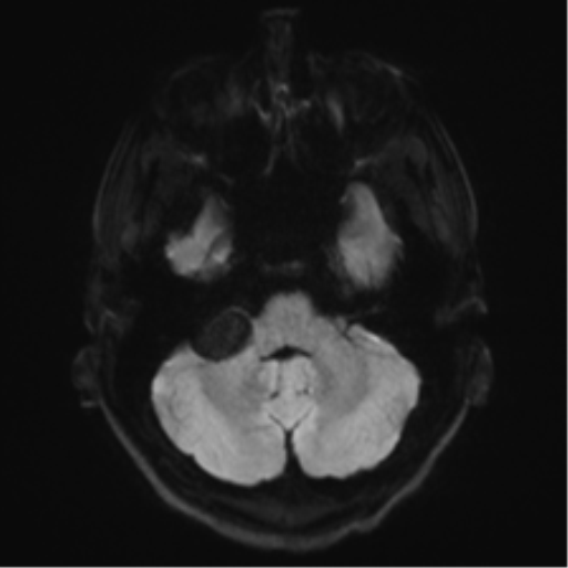 Arachnoid cyst - cerebellopontine angle (Radiopaedia 59689-67083 Axial DWI 44).png