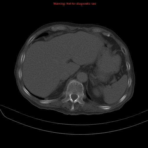 File:Arachnoiditis ossificans (Radiopaedia 51394-57136 Axial bone window 5).jpg