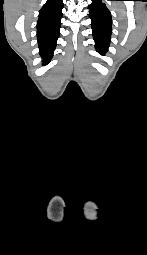 Arrow injury to the chest (Radiopaedia 75223-86321 E 98).jpg