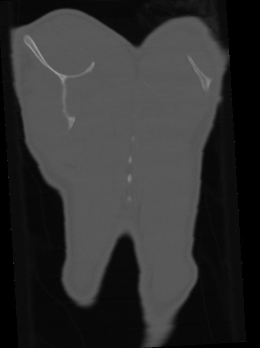 Arrow injury to the neck (Radiopaedia 75225-86323 Coronal bone window 112).jpg