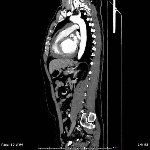 File:Ascending aortic aneurysm (Radiopaedia 50086-55404 C 43).jpg