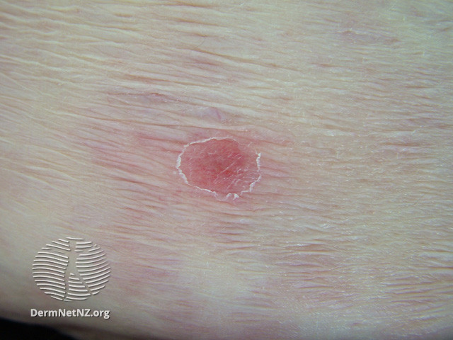 File:Aspergillus skin lesion (DermNet NZ fungal-aspergillus).jpg