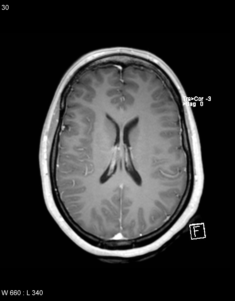 Astroblastoma (Radiopaedia 39792-42218 Axial T1 C+ 29).jpg