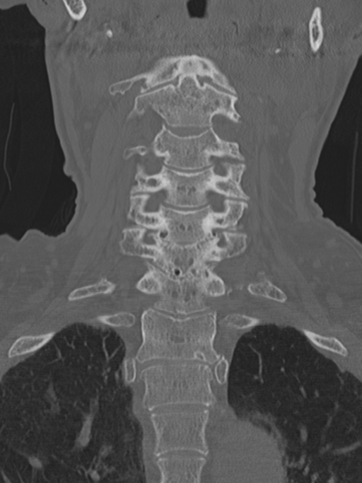 Atlanto-axial subluxation (Radiopaedia 36610-38176 Coronal bone window 22).png