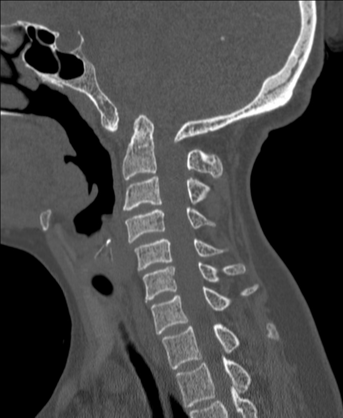 Atlanto-occipital assimilation with basilar invagination (Radiopaedia 70122-80188 Sagittal bone window 54).jpg