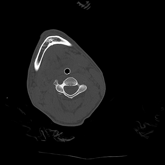 File:Atlanto-occipital dissociation (Traynelis type 1), C2 teardrop fracture, C6-7 facet joint dislocation (Radiopaedia 87655-104061 Axial bone window 41).jpg