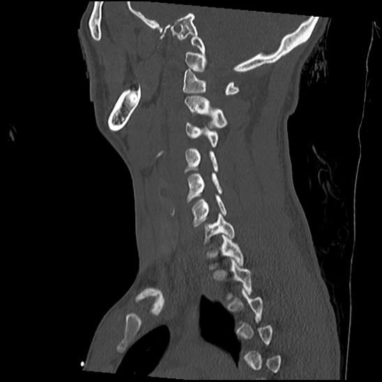 Atlanto-occipital dissociation (Traynelis type 1), C2 teardrop fracture, C6-7 facet joint dislocation (Radiopaedia 87655-104061 Sagittal bone window 44).jpg