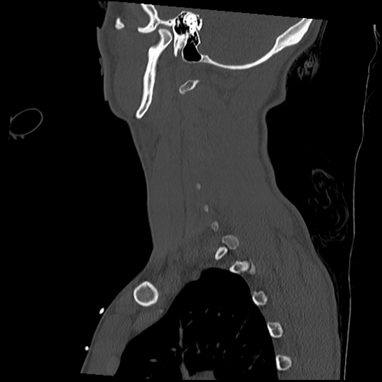 Atlanto-occipital dissociation (Traynelis type 1), C2 teardrop fracture, C6-7 facet joint dislocation (Radiopaedia 87655-104061 Sagittal bone window 54).jpg