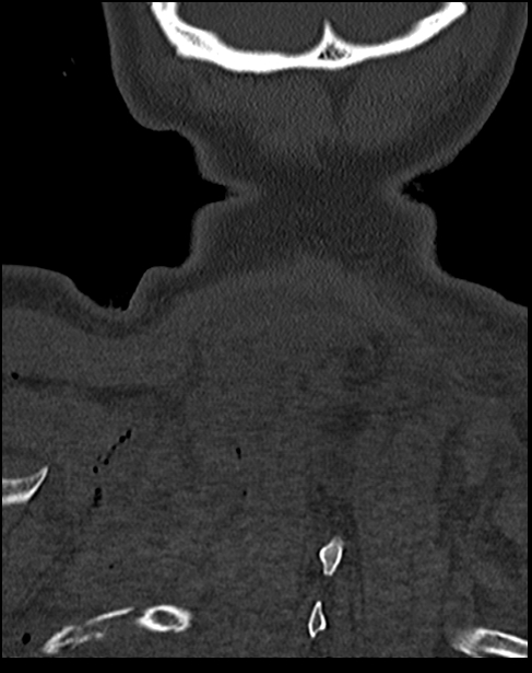 Atlanto-occipital dissociation - Traynelis type 1 (Radiopaedia 87570-103948 Coronal bone window 57).jpg