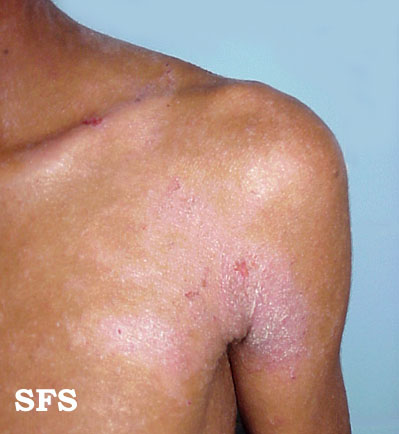 Atopic Dermatitis (Dermatology Atlas 8).jpg