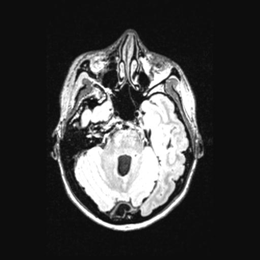 Atretic encephalocoele with inferior vermis hypoplasia (Radiopaedia 30443-31108 Axial 50).jpg