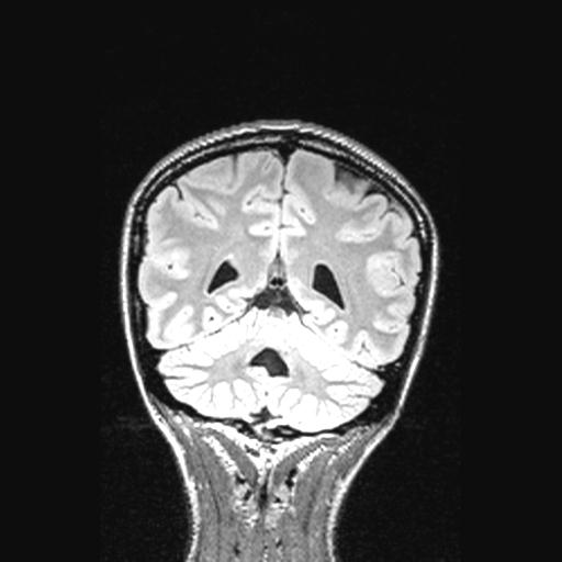Atretic encephalocoele with inferior vermis hypoplasia (Radiopaedia 30443-31108 Coronal FLAIR 60).jpg