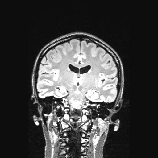 Atretic encephalocoele with inferior vermis hypoplasia (Radiopaedia 30443-31108 Coronal FLAIR 89).jpg