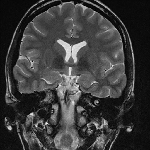 File:Atretic encephalocoele with inferior vermis hypoplasia (Radiopaedia 30443-31108 Coronal T2 10).jpg
