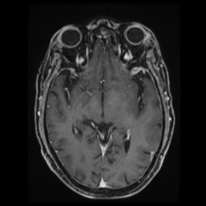 Atypical meningioma (Radiopaedia 45535-49629 Axial T1 C+ 35).jpg