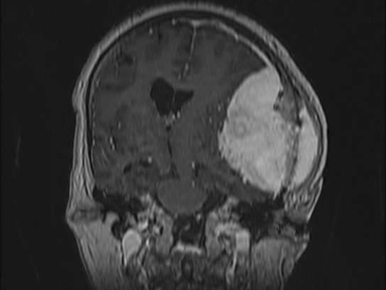 Atypical meningioma (Radiopaedia 62985-71406 Coronal T1 C+ 59).jpg