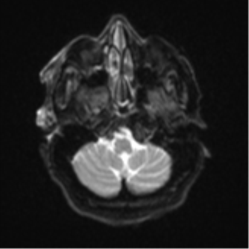 Atypical meningioma (WHO Grade II) (Radiopaedia 54742-60981 Axial DWI 5).png