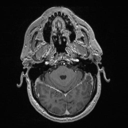 Atypical meningioma (grade II) - en plaque (Radiopaedia 29633-30147 Axial T1 C+ 55).jpg
