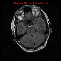 File:Atypical meningioma - grade II (Radiopaedia 13303-13305 Axial FLAIR 7).jpg
