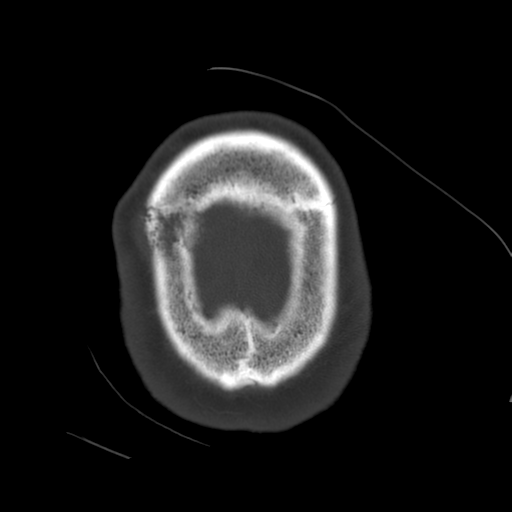 Atypical meningioma with skull invasion (Radiopaedia 34357-35649 Axial bone window 74).png