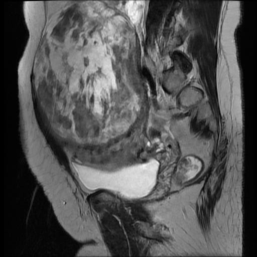 File:Atypical retroperitoneal lymphocoeles with large leiomyoma of uterus (Radiopaedia 32084-33027 Sagittal T2 12).jpg