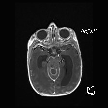 Atypical teratoid rhabdoid tumor (prenatal US and neonatal MRI) (Radiopaedia 59091-66388 Axial T1 C+ 25).jpg
