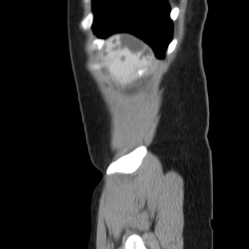 Autosomal dominant polycystic kidney disease (Radiopaedia 23061-23093 F 5).jpg