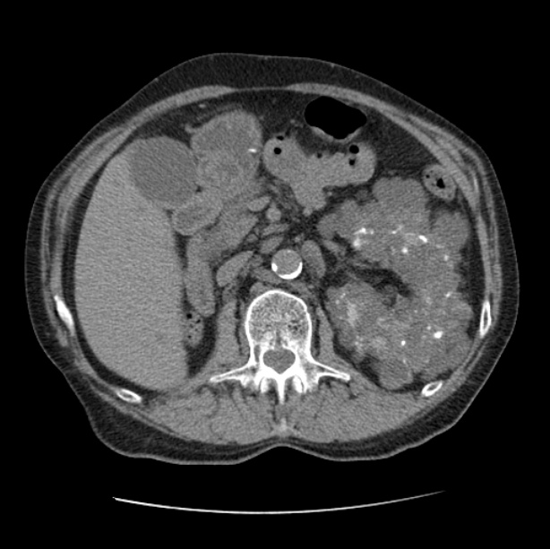 Autosomal dominant polycystic kidney disease (Radiopaedia 27851-28094 Axial non-contrast 67).jpg