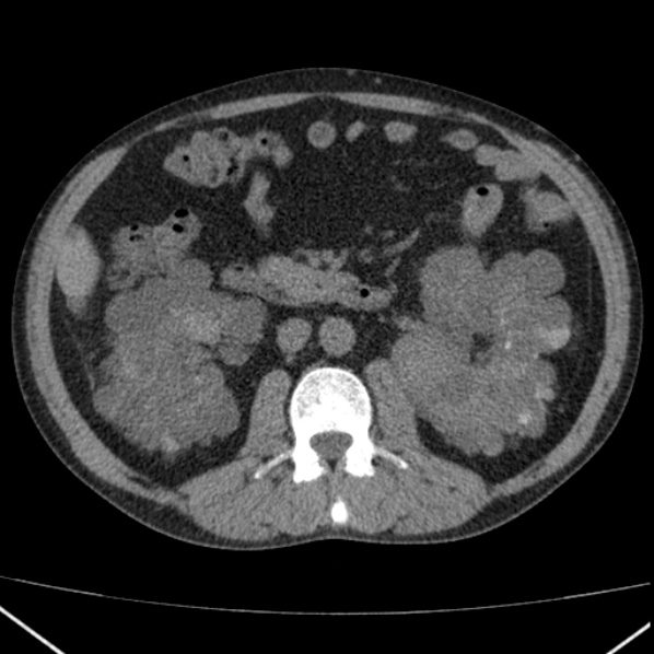 File:Autosomal dominant polycystic kidney disease (Radiopaedia 36539-38101 Axial non-contrast 39).jpg