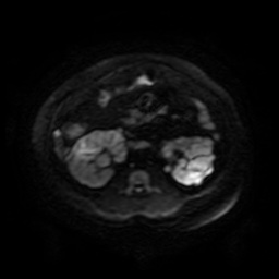 File:Autosomal dominant polycystic kidney disease (Radiopaedia 50259-55611 Axial DWI 61).jpg