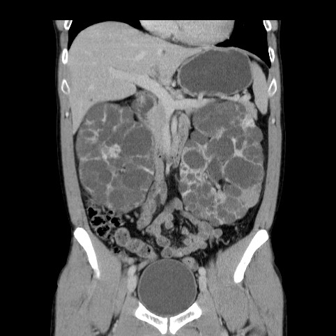 File:Autosomal dominant polycystic kidney disease (Radiopaedia 66349-75582 A 31).jpg