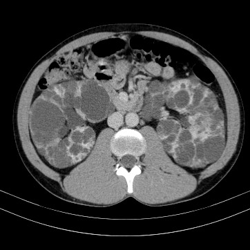 Autosomal dominant polycystic kidney disease (Radiopaedia 66349-75582 B 43).jpg