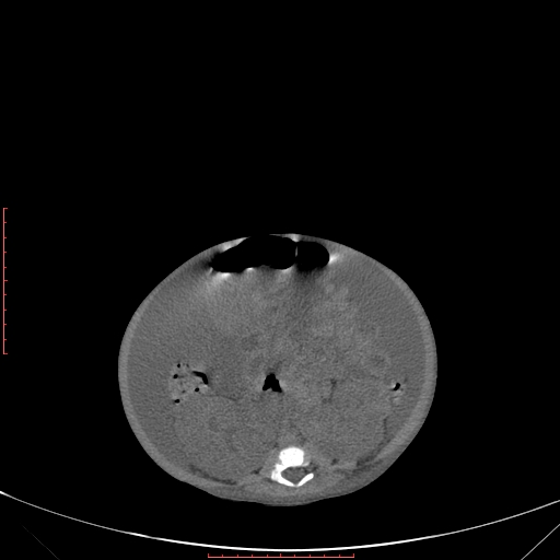 Autosomal recessive polycystic kidney disease associated with Caroli disease (Radiopaedia 61932-69984 Axial non-contrast 240).jpg