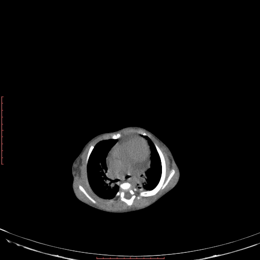 Autosomal recessive polycystic kidney disease associated with Caroli disease (Radiopaedia 61932-69984 B 49).jpg