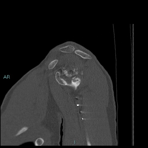 Avascular necrosis after fracture dislocations of the proximal humerus (Radiopaedia 88078-104655 Sagittal bone window 26).jpg